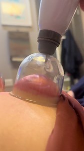 🏆 Cupping therapy decompresses fascia and muscle to improve circulation, reduce stiffness, and support recovery. #Cupping #DrKyleRoss #chiropractor