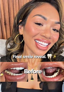 Smile Makeover Journey: Cleaning, Whitening & Crowns Reveal