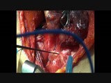 Intraoperative Recurrent Laryngeal Nerve Monitoring During Thyroidectomy by Using NIM-Response 3.0 • Video • MEDtube.net
