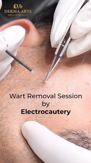 11 reactions | Wart is a small skin growth caused by viral...