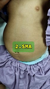 Floppy child with Bell shape chest #sma #myopathy #neuropathy | Dr. Arshad Mehmood - Child Specialist