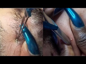 ASMR Face Picking EXTRACTIONS in new Camera {allzoomed} | Extremely satisfying