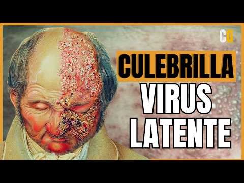 Shingles (Herpes Zoster) - How does it cause so much PAIN?