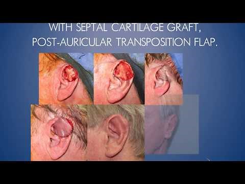 Ear Reconstruction
