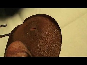 Epidermoid Cyst Extraction | Dr. Steven Greene in Seattle