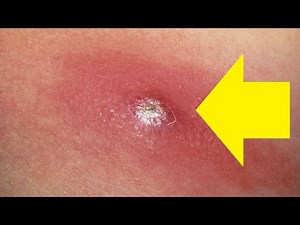 how to get rid of a boil on your nose fast