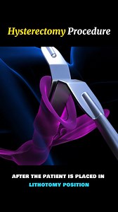 Hysterectomy Procedure 3D Animation #hysterectomy #hysteroscopy #surgery #cervix #medical | Info Insider