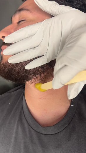 Men’s beard waxing using hard wax ✨ . . . . #breaesthetician #breawaxing #waxspecialist #waxing #ocwaxer #explorepage #ocesthetician #asmr #oddlysatisfying | Stripped Skin by Anna M