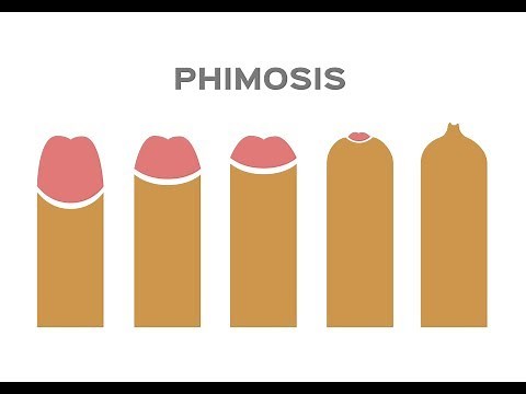 Phimosis rings and foreskin stretching