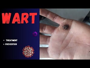 Wart - All types with pictures - Treatment and prevention