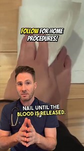 Draining a subungual hematoma at home. #subungualhematoma #smashedtoe #smashedfinger #medicalprocedure #doityourself | Doctor Joe