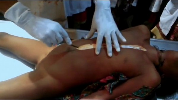 Medical Autopsy Video on a Woman