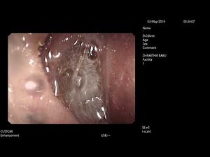 High definition view of villi in terminal Ileum