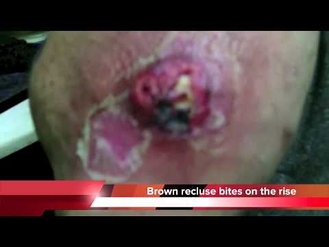 Brown recluse spider bites on the rise