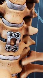 61K views · 332 reactions | Need to understand how bone fusion healing works after surgery or injury? This video breaks down the stages of spinal fusion recovery, bone graft healing, and what to expect during the bone fusion process. | Spine-health | Facebook