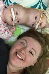 6.6K views · 54 reactions | Against all odds, craniopagus twins,...