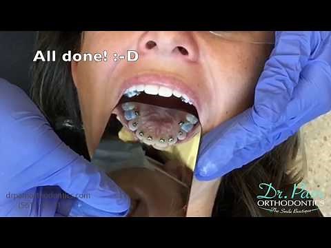 Placing lingual / inside braces step-by-step