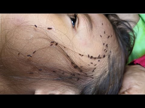 Remove all hundred lice from hair - Getting out all of big lice from head
