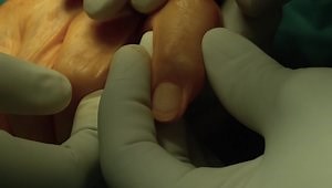 Distal Interphalangeal Joint Fusion Surgery with an Allograft