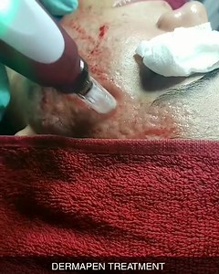 ACNE TREATMENT | Luxury El VIP SPA