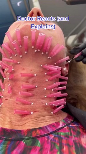 Should you thread to improve collagen in your skin? Video credit: @Francine Young, RN MEP-C #collagen #threading #collagenstimulation