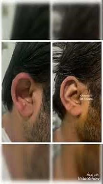 Best otoplasty in Pakistan, lahore