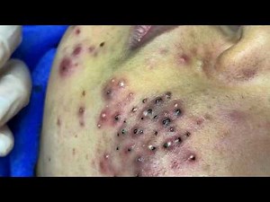 Blackhead Removal With Sac Dep Spa @776