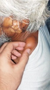 93K views · 212 reactions | Large Tumour near neck | Dr. Khaled Hasan Milu | Facebook