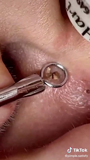 blackheads removal from the ear #satisfying #acne #pimple #fyp #foryou #blackheadsremoval #blackheads #blackhead