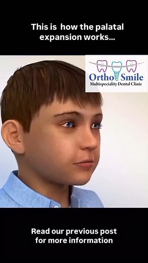 Orthodontic Appliance Rapid Palatal Expansion | Ortho Smile Multispeciality Dental Clinic