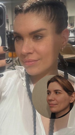 ✨ “Temporal Lift and Rhinoplasty: 6-Month Results” ✨ In this video, observe the 6-month post-op results of our patient’s temporal lift and rhinoplasty. The recovery process has led to a natural enhancement of facial features and a harmonious balance of the nose. 🌟 🔹 The temporal lift has achieved a noticeable rejuvenation in the brow area, while the rhinoplasty has perfected the facial harmony. 🔹 Our patient is extremely satisfied with the results and continues daily life with newfound confid