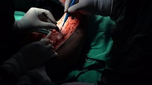 Arm Lift Surgery Skin Removal Plastic Stock Footage Video (100% Royalty-free) 1109928151 | Shutterstock