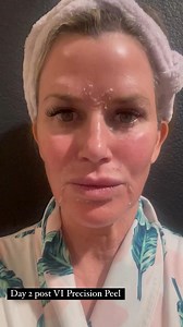 1.1K views · 26 reactions | Get ✨glowing✨ skin this winter season with a VI Peel! @juliajacobsskincareboutique received a #VIPeel Precision Plus, and the results are incredible. Upgrade your skin this season by heading to the link in our bio to find a location near you. | VI Peel | Facebook