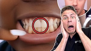 5.8K views · 68 reactions | How to Get Veneers That DON’T Ruin Your Real Teeth! #teeth #veneers #dentist | TheBentistofficial | Facebook