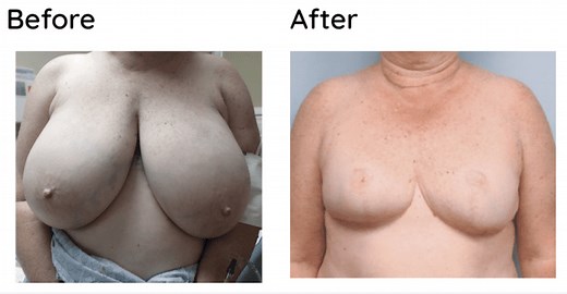 Goldilocks Mastectomy and Reconstruction