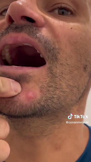 The Solè Water has cured the rest of the pimples and bad feeling (getting bloods soon to check Fatty Liver ect). Can someone tell me what this particular thing is, cause it aint a notmal pimple. #dermatologist #dermdoctor #pimple #subway #conanmvisser #conanvisser #docuseries #theicaniwillshow