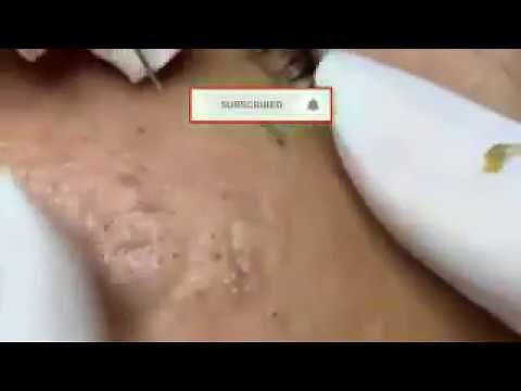 Extracion de espinillas y barros