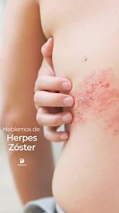 Todos podemos tener Herpez Zóster, es un virus que puede vivir dormido en nuestro cuerpo después de haber tenido varicela y cuando se vive mucho estrés o una enfermedad fuerte llega a manifestarse físicamente 👩‍⚕️Consultas Consulta presencial $1000 pesos Consultas Virtuales $900 pesos 👉AGENDA dandole click https://wa.link/bgaq0u ☎️Tel 6815025 ⏰Horario 10am a 3pm. 📲Whatsapp 1 (619) 721-6669 . #tijuana #derma #dermatologa #dermatologo #piel #cuidadopiel #botox #fillers #relleno #acne #skincare 