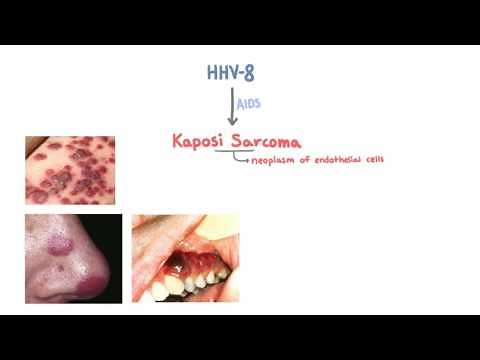 HHV-8 and Kaposi Sarcoma