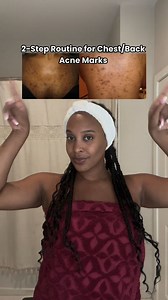Chest acne? Back bumps? We're not gatekeeping 🌟🌟🌟🌟🌟 | UrbanSkinRx