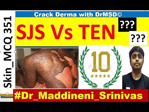 Lyell's syndrome | Toxic Epidermal Necrolysis | TEN | Stevens Johnson Syndrome | SJS | Targetoid |