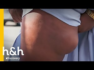 Novia sufre enorme lipoma en su pierna | Dra. Sandra Lee: Especialista en Piel | Discovery H&H