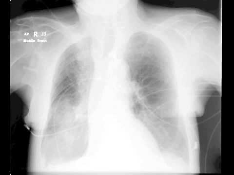 Pulmonary infiltrates in ICU