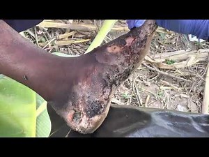 Wafula’s jiggers and rot - WRONG treatments damaged his feet - subscribe @.net to see full vids