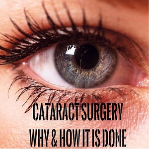 Cataract Surgery Why & How It Is Done | Naturally Yours