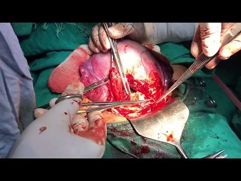 Cesarean delivery / C-section : Surgical technique - HD Video