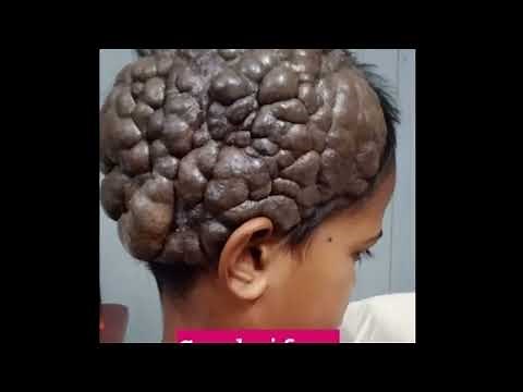 Cerebriform intradermal nevus (CIDN) presenting as Cutis verticis gyrata (CVG)