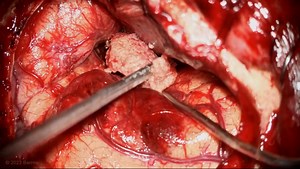 #222: Pterional Craniotomy for Resection of a Giant Clinoidal and Cavernous Sinus Meningioma  - Tumor - Seven Series Collection