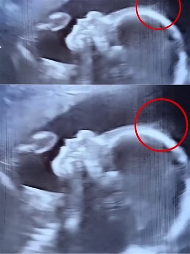 Les médecins n’en croyaient pas leurs yeux lors de l’échographie — aujourd’hui, ce bébé fait fondre les cœurs partout où elle passe « Attendez — c’est bien ce qu’on voit à l’échographie ?! » 😲📸 Ce qui est apparu à l’écran lors du contrôle de routine à 20 semaines a laissé tout le monde à la clinique sans voix — et quand la petite Holly est enfin arrivée, la surprise était encore plus grande. Elle n’a que quatre mois, mais elle fait déjà tourner les têtes partout où elle va. Faites défiler vers