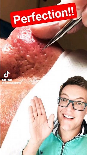 Stunning BLACKHEAD REMOVAL - Crazy Satisfying #shorts